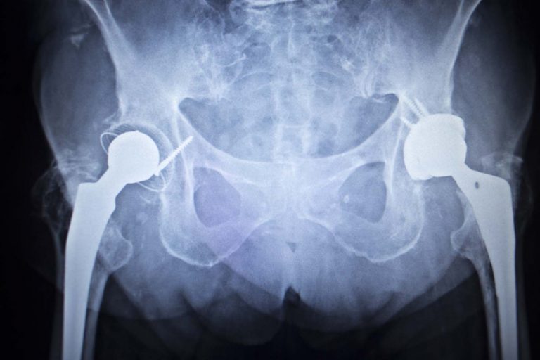 Hip Replacement Systems